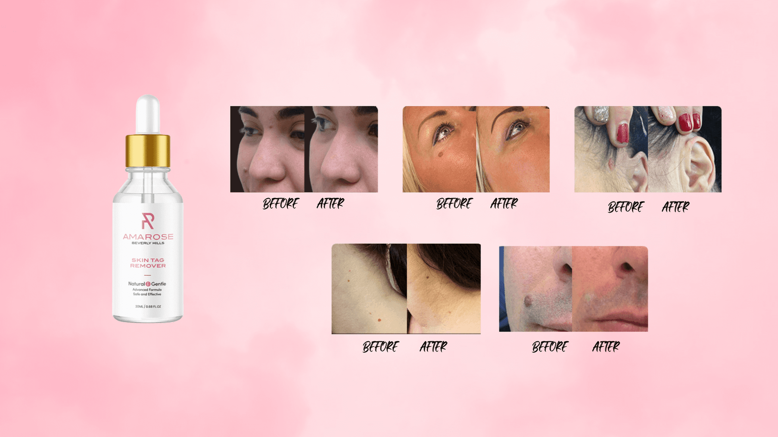 Amarose Skin Tag Remover Results