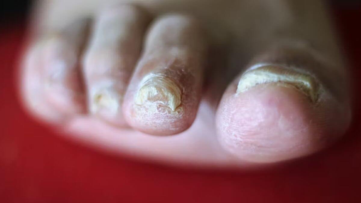 Symptoms Of Nail Infections